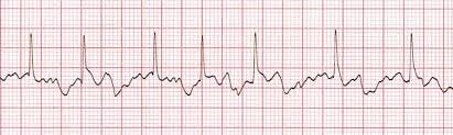 Atrial Fibrillation training - ACLS Cardiac Rhythms video | ProACLS