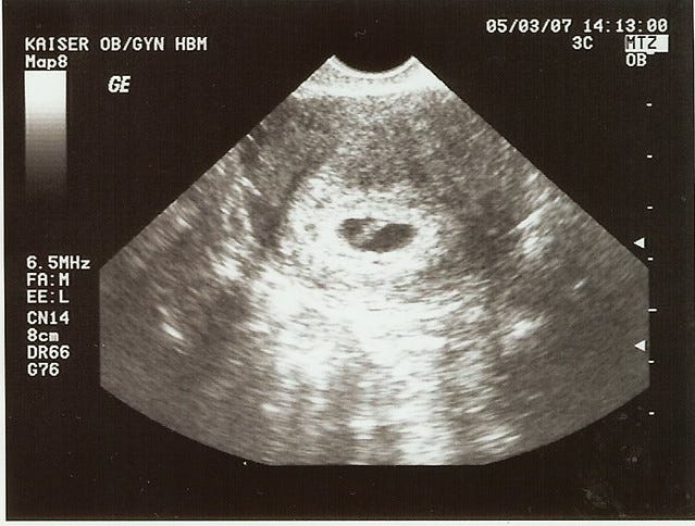 Internal ultrasound at 6 weeks | 3 MAY 07 | Sassy Pamela | Flickr