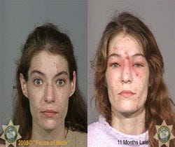 Photo of a Face of Meth (Left) and 11 Months later (right)