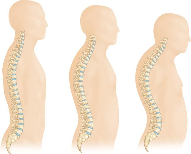 Osteoporosis and Spinal Fractures - OrthoInfo - AAOS