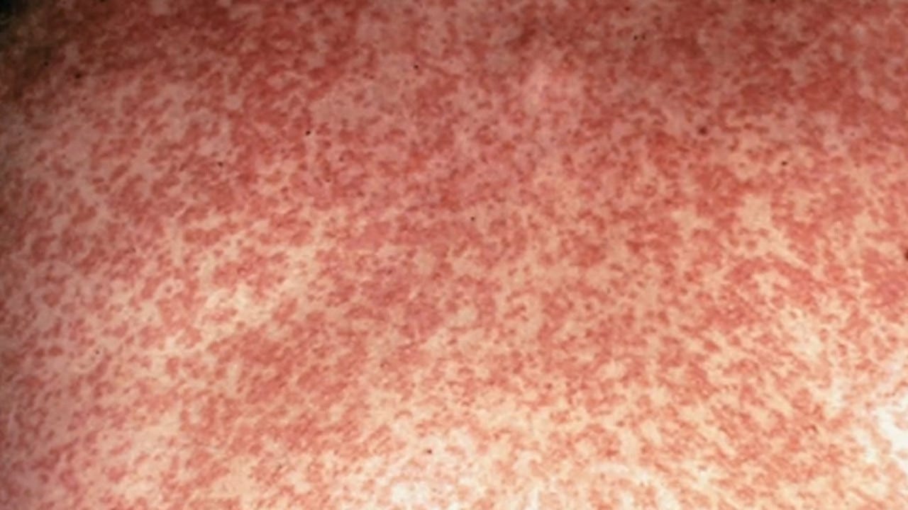 The characteristic measles rash emerges three to four days after initial symptoms appear. Picture: Supplied