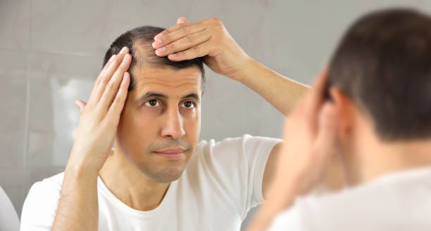 Hair loss man controls hair loss and unhappy gazing at you in the mirror sad bald stock pictures, royalty-free photos & images