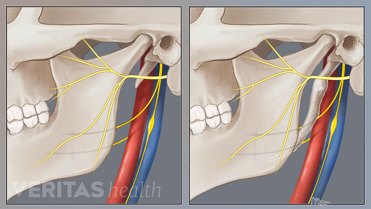 Neck Pain from Eagle Syndrome