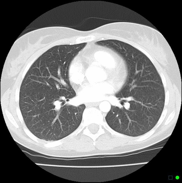 Normal chest CT - lung window | Radiology Case | Radiopaedia.org