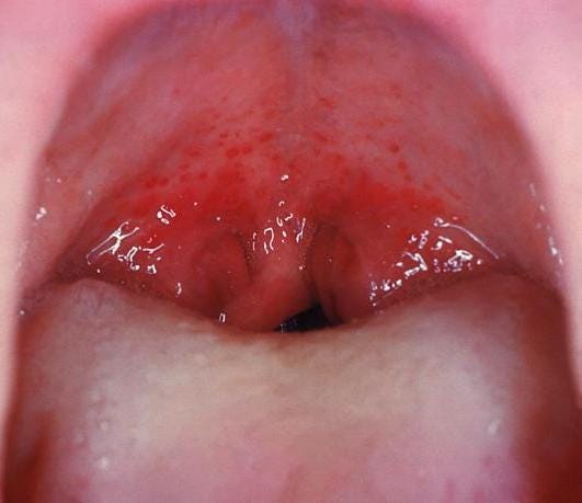 Red spots on the roof of the mouth is considered very specific for Strep throat.