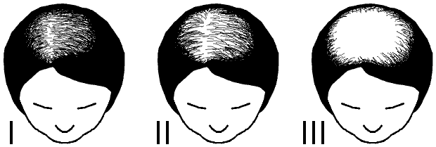 File:Ludwid scale for female pattern baldness.png