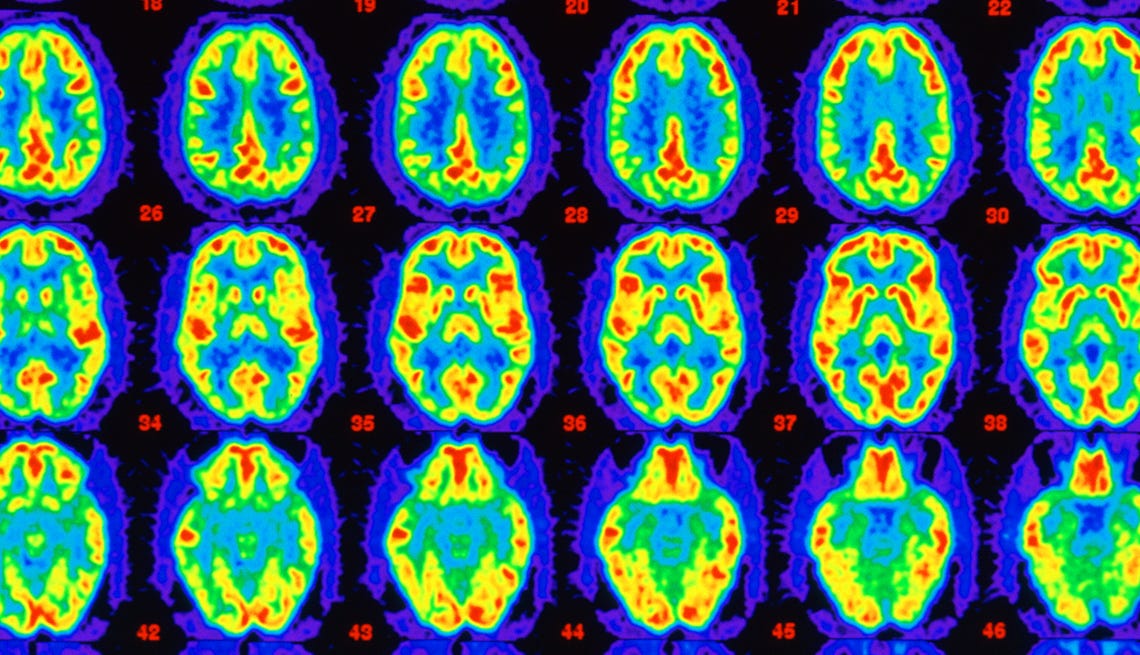 Redefining Alzheimer's May Help Diagnose Disease Faster