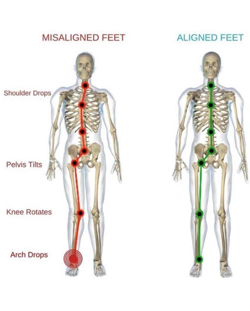 May be an image of bone and text that says 'MISALIGNED FEET ALIGNED FEET Shoulder Drops Pelvis Tilts Knee Rotates Arch Drops'