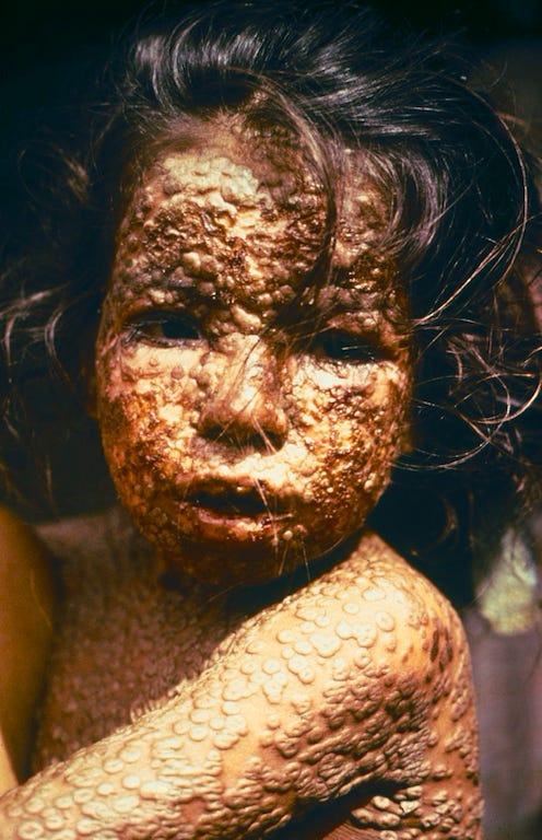 A Bangladeshi child with smallpox