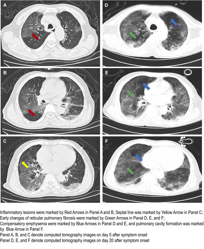 Imaging changes of severe COVID-19 pneumonia in advanced stage ...