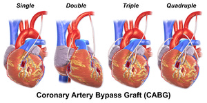Coronary artery bypass surgery - Wikipedia