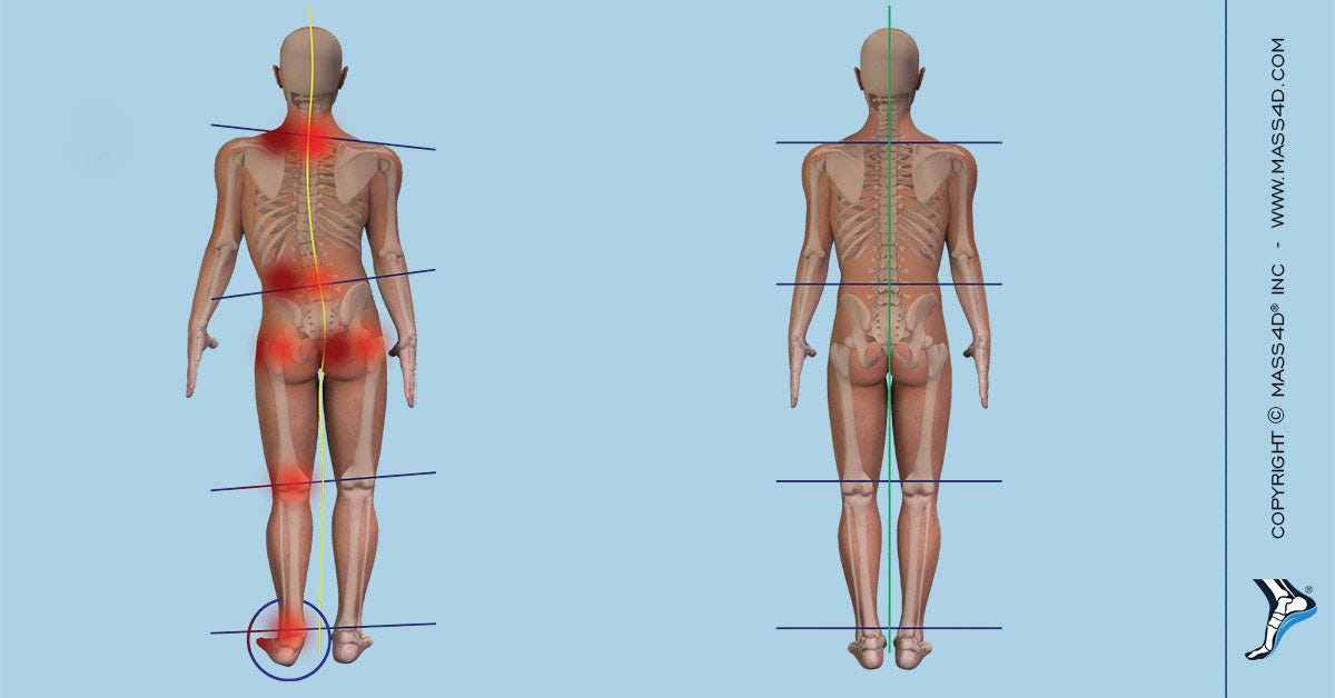 Understanding Leg Length Discrepancy (LLD) - MASS4D® Foot Orthotics