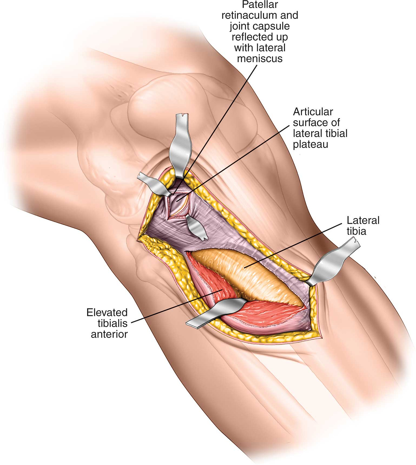 medical illustration of knee surgery