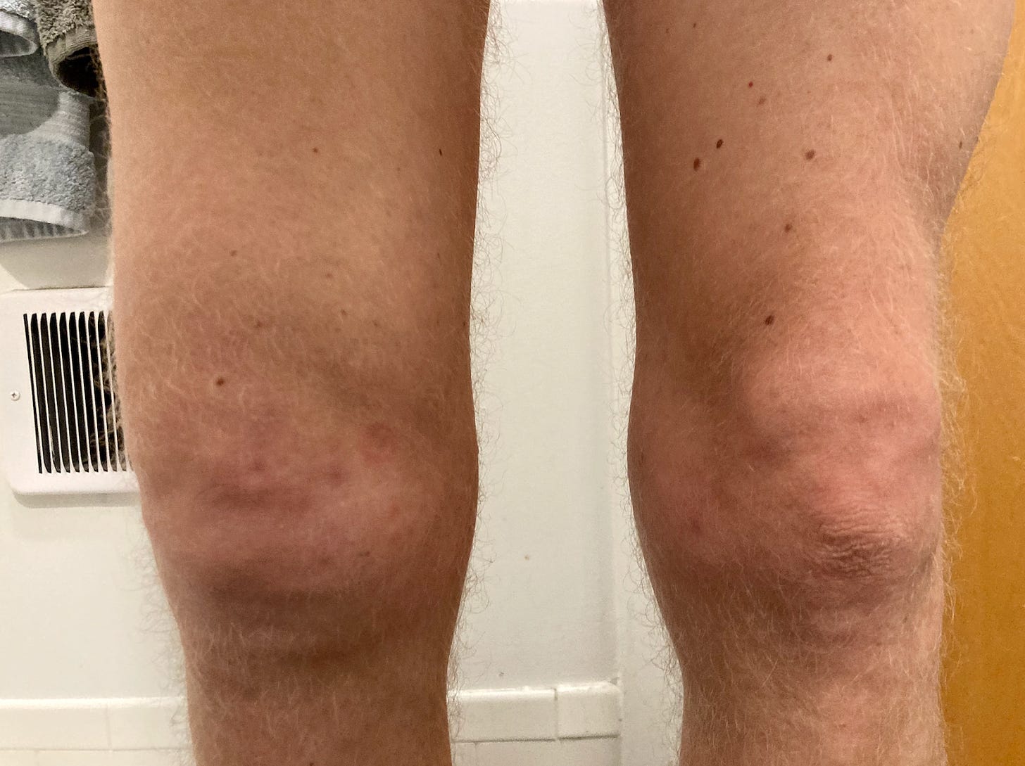 My knees, one of them is normal the other is the size of a small melon...
