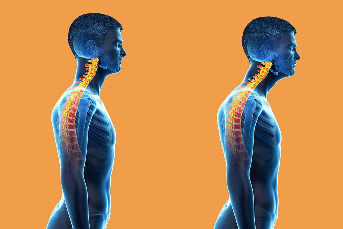 The Best Ways to Fix Forward Head Posture (Nerd Neck)