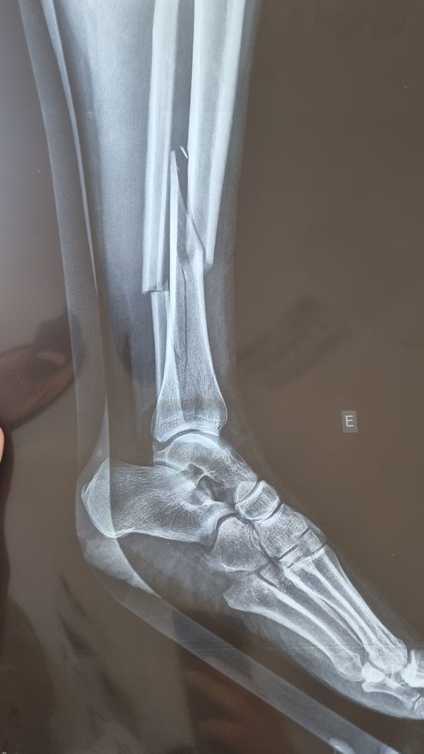 Imagem de raio X mostrando uma fratura completa dos ossos da perna, eles partiram e ficaram bem desalinhados