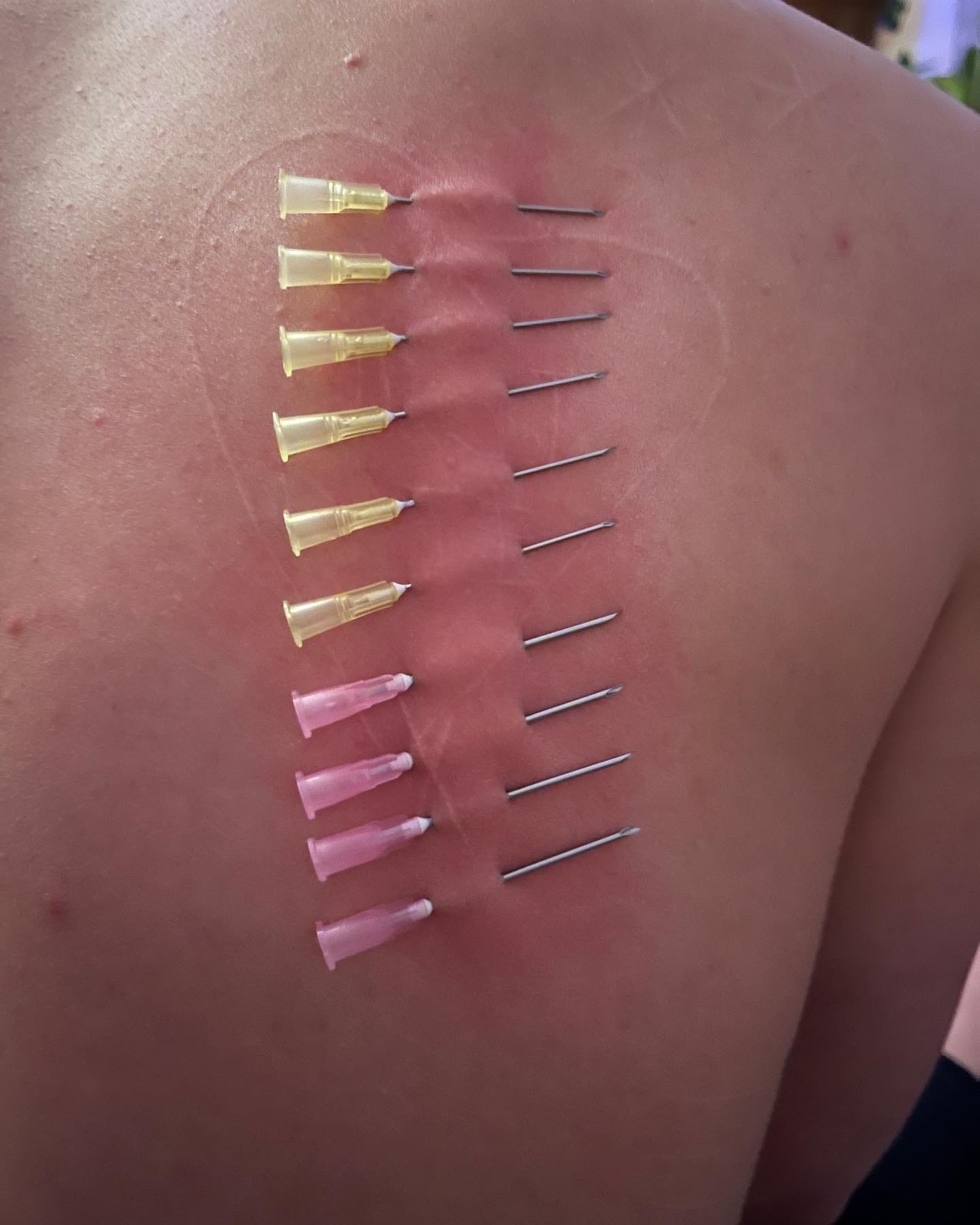 image of David's back with ten needles inserted into their skin
