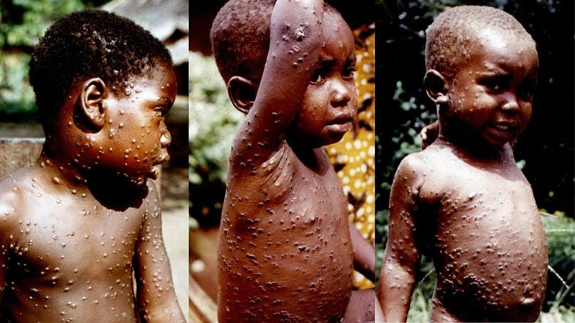 Monkeypox: What we know about the smallpox-like virus spreading in Europe, the US and Canada | Euronews Monkeypox: What we know about the smallpox-like virus spreading in Europe, the US and Canada | Euronews