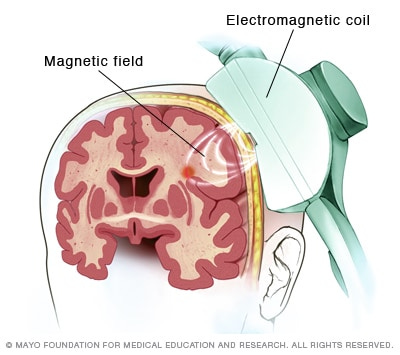 Transcranial magnetic stimulation - Mayo Clinic