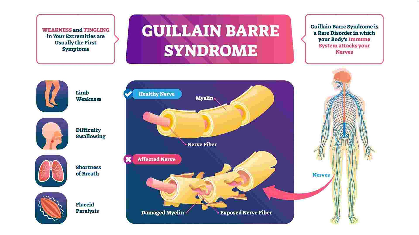 What Is Guillain-Barre Syndrome That Some Are Getting Post COVID-19 - Odisha Bytes