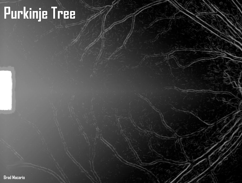 First person view of a Purkinje Tree while sitting in a slit lamp/biomicroscope