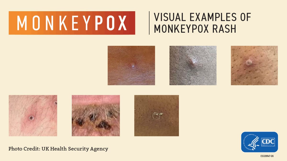 Monkeypox, visual examples of monkeypox rash. Photo series of various presentations of the monkeypox rash on patients.