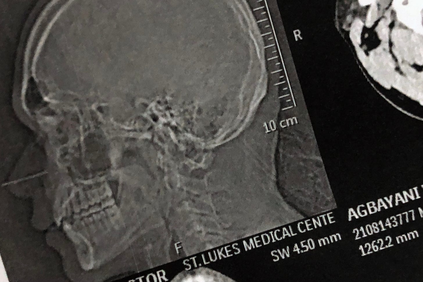 X-ray and CT scan of author's head.