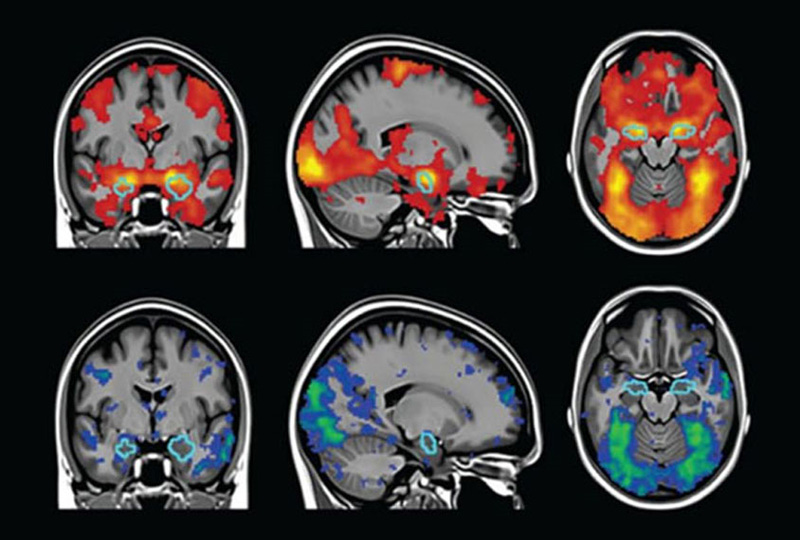 How Scientists Are Tackling Brain Imaging's Replication Problem | The  Scientist Magazine®