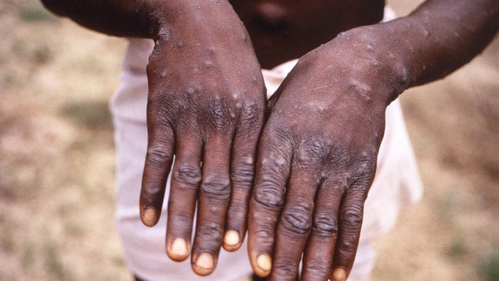 WHO to share vaccines to stop monkeypox amid inequity fears - ABC News