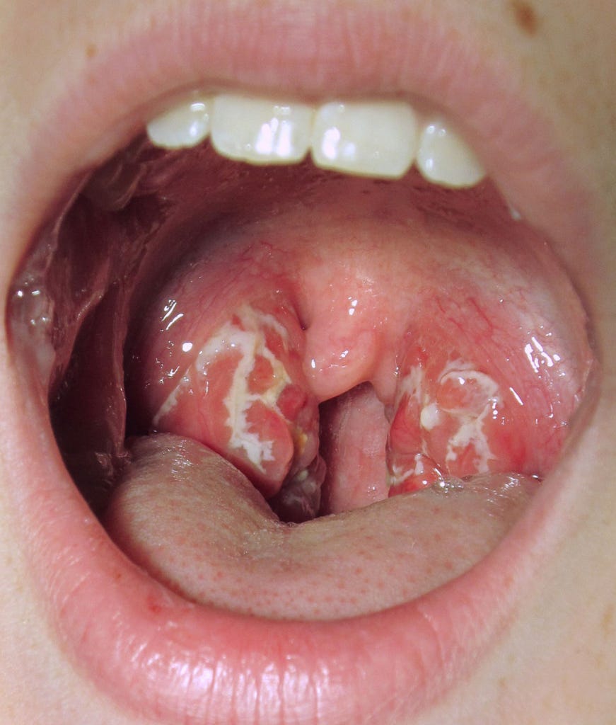 Strep throat sometimes causes white patches on the tonsils. This is called exudate. Exudate is found in other conditions, so you can't use it alone to diagnose Strep throat.