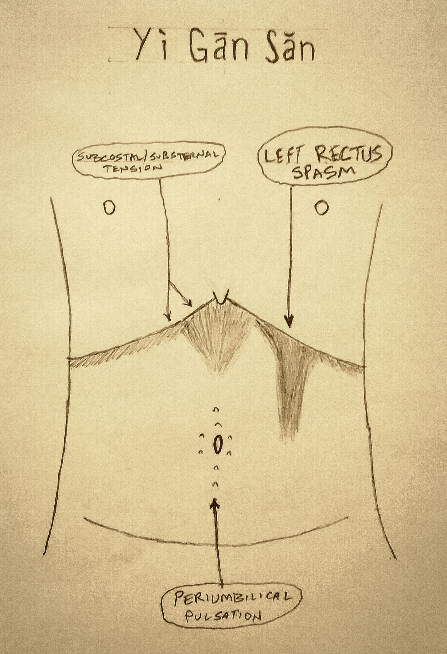 Abdominal diagnostic conformation for Yi Gan San, showing a drawing of the chest and abdomen with shaded areas indicating left rectus spasm, subcostal/substernal tension, and periumbilical pulsation,