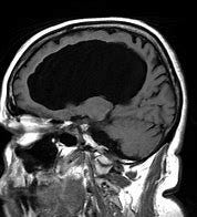 Image result for free image of hydrocephalus mri