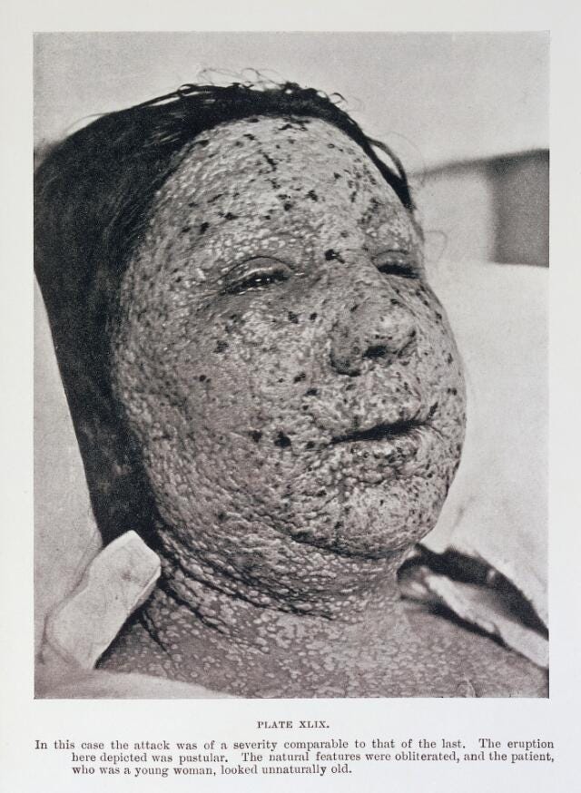 WC585 1908R53d
"The Diagnosis of Smallpox", Ricketts, T. F,
Casell and Company, 1908
Plate XLIX, The eruption of pustular smallpox on
the face of a woman.