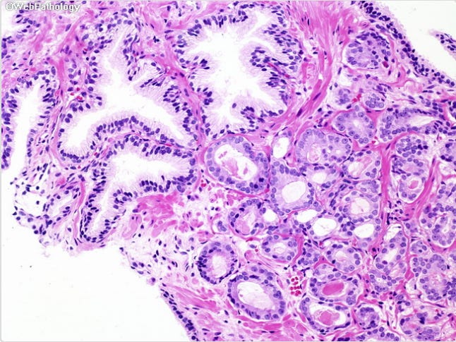 A pinkish microscope image of perforated-looking tissue, with larger holes above.