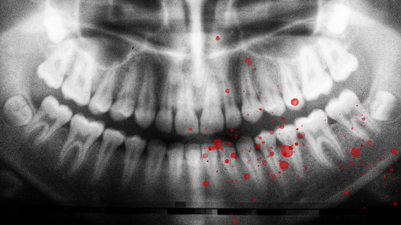 An image of an X-ray examination of human teeth.
