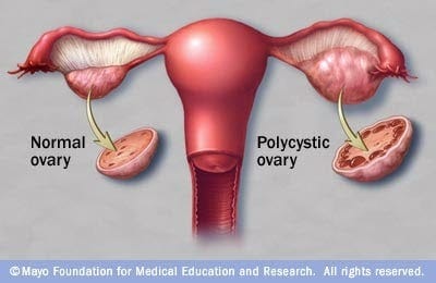 Polycystic Ovary Syndrome (PCOS) - New study shows delays in diagnosis