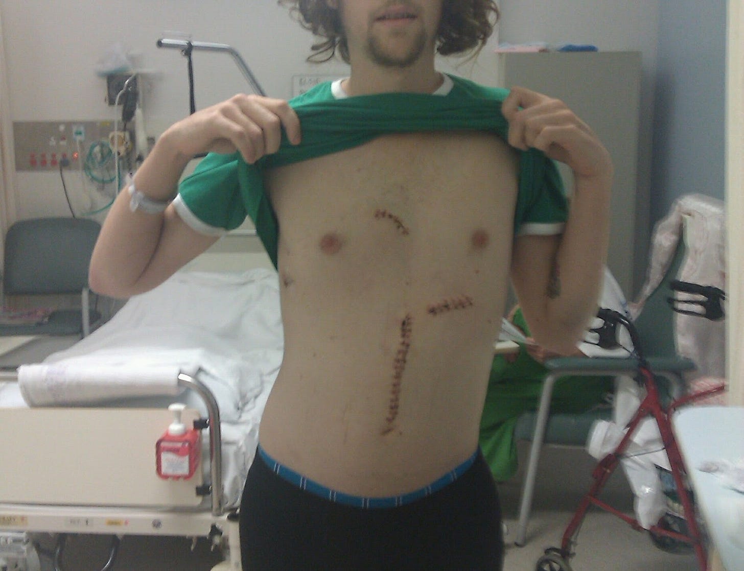 Matt lifting his shirt up after surgery, showing his three scars - they are long and pretty brutal.