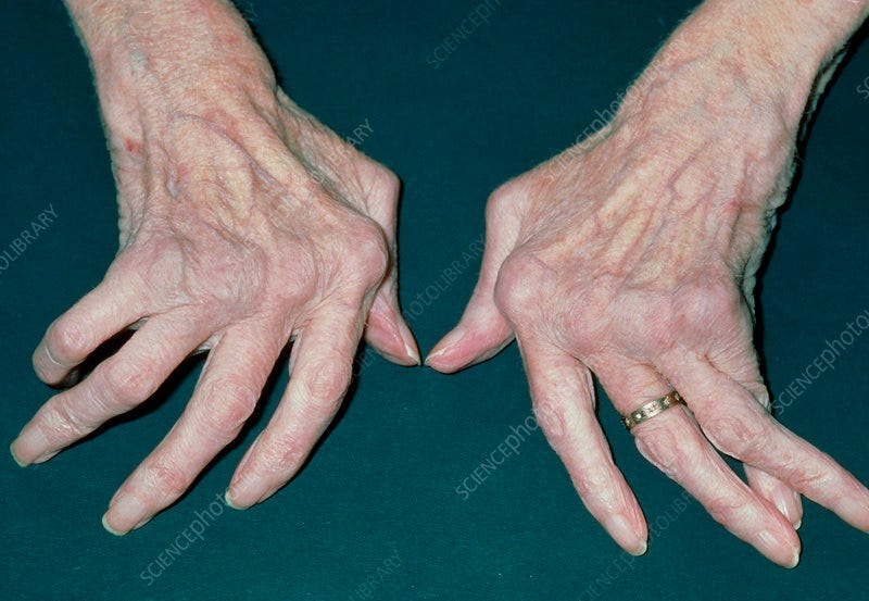 Woman's hands crippled with rheumatoid arthritis - Stock Image - M110/0349  - Science Photo Library