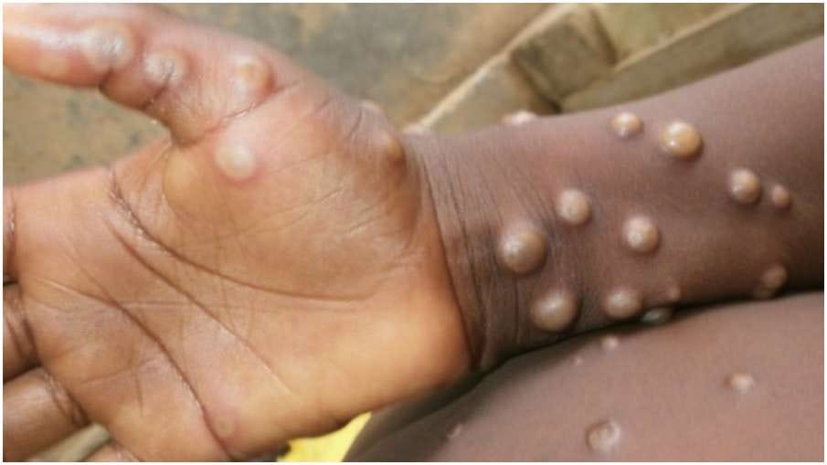 Monkeypox outbreak spreads to Europe as U.K, Portugal confirm cases