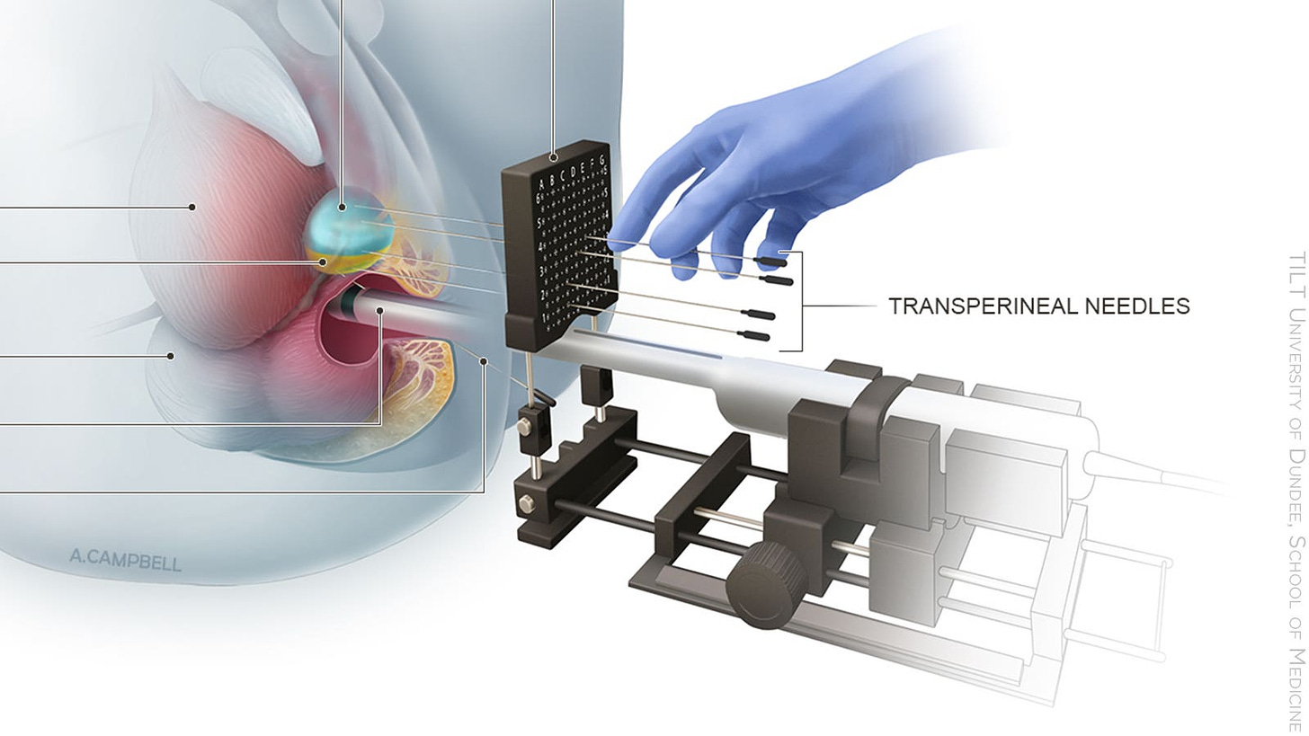 A medical illustration of a transperineal biopsy