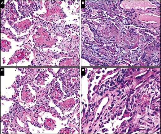 Fibrinous exudates and interstitial inflammation in vaping-related lung injury. A, B, Fibrinous exudates within airspaces (A, case 1, H&E, ×200; B, case 3, H&E, ×200). C, Interstitial inflammation, case 1 (H&E, ×200). D, Interstitial inflammatory infiltrate at high magnification, showing lymphocytes and a rare eosinophil (case 2, H&E, ×400).