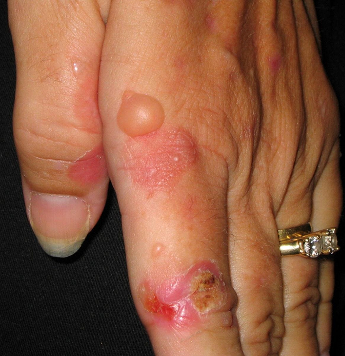Поздняя кожная порфирия - клиническая гастроэнтерология и гепатология