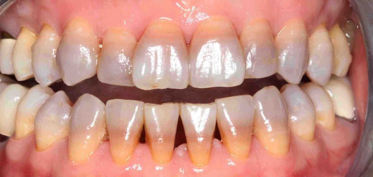 Tetracycline and Tooth Staining - Although the antibiotic tetracycline is effective in ...