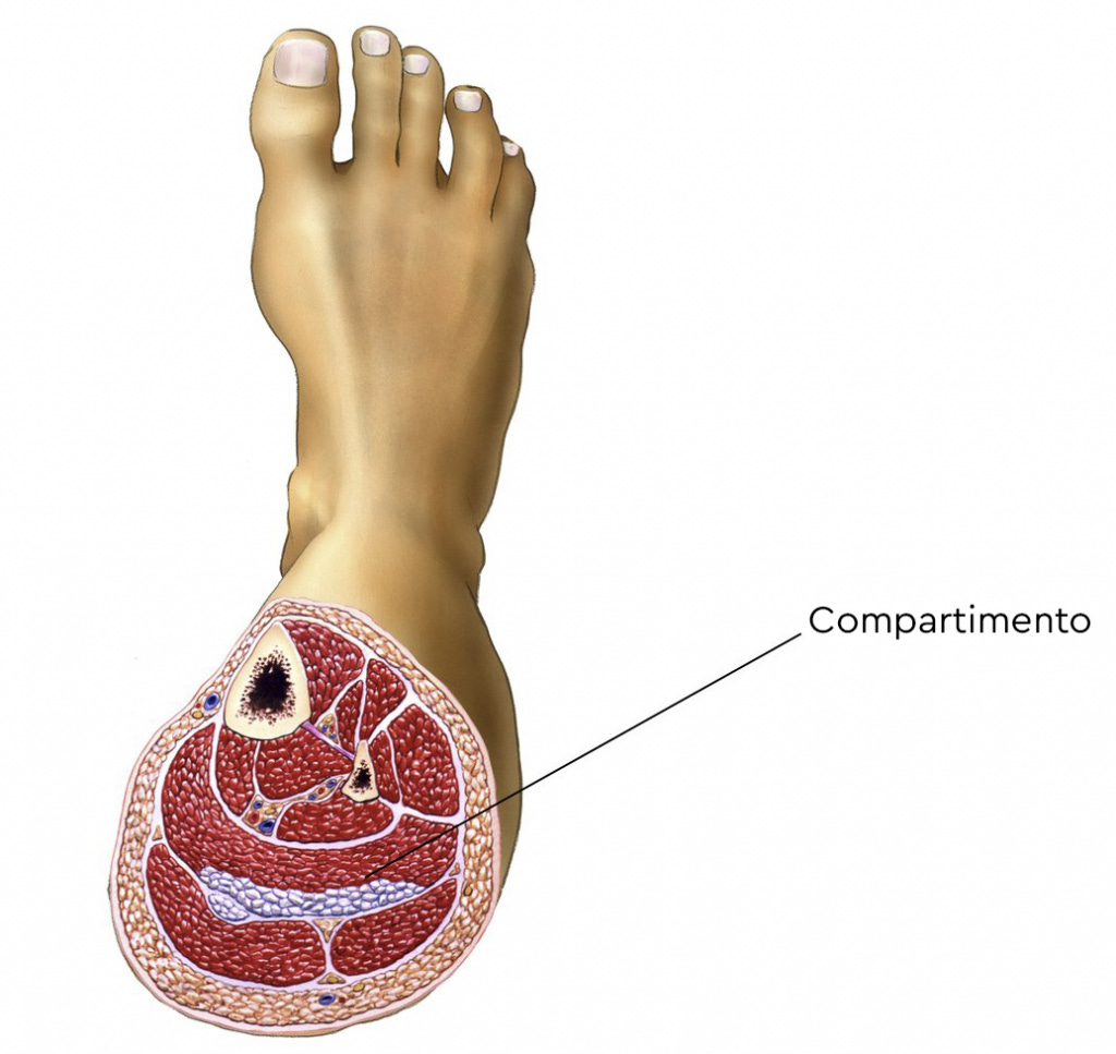 síndrome compartimental