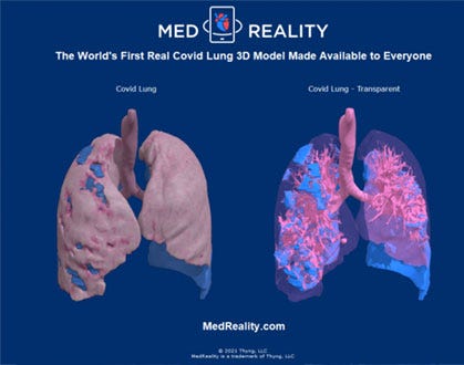 3D Medical Imaging Illustrates Damage COVID-19 Causes