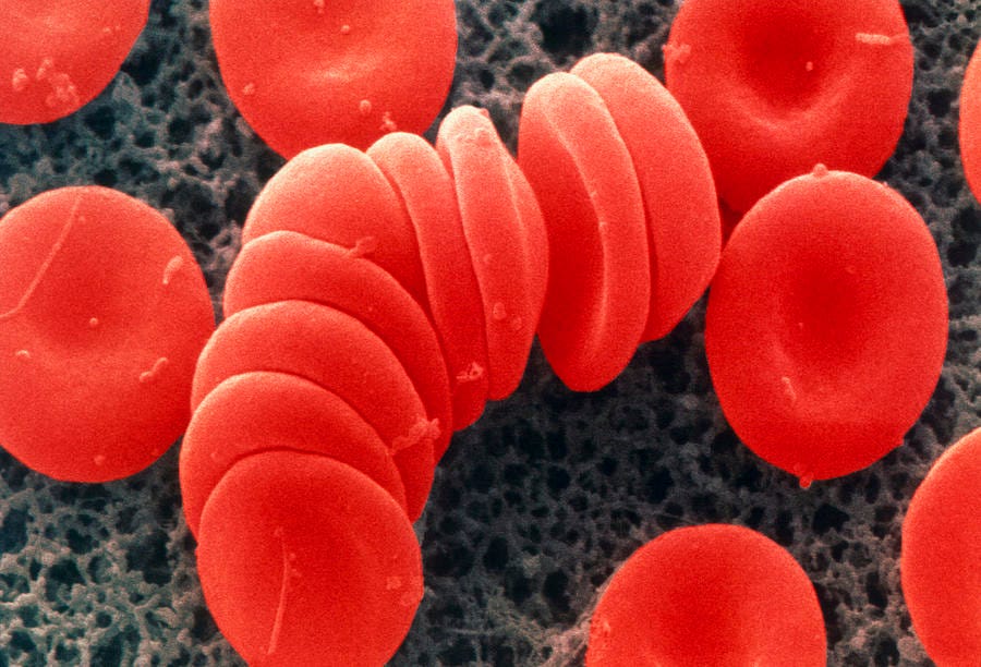 Coloured Sem Of Red Blood Cells, Rouleau Formation ...