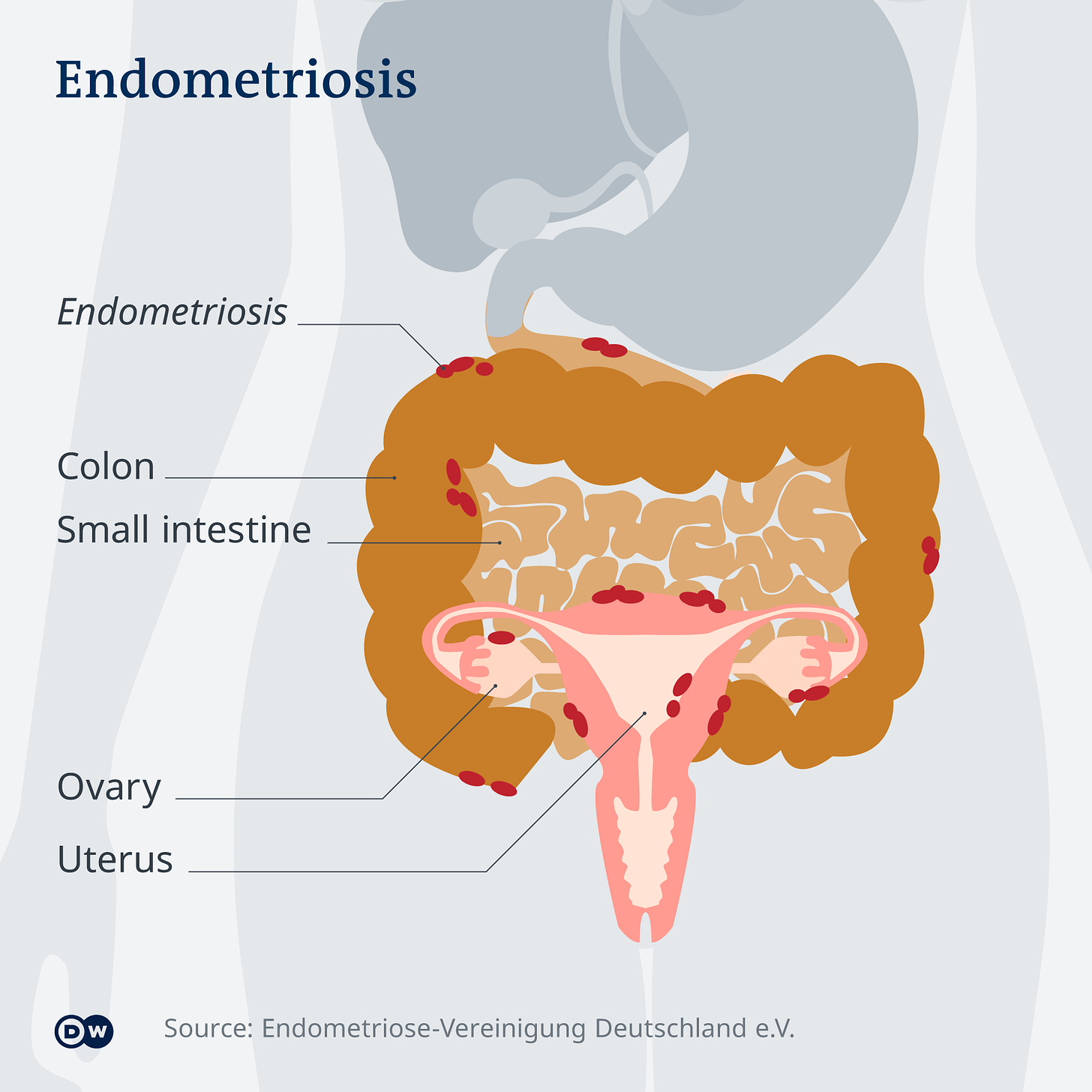 Endometriosis: The long wait for a diagnosis | Science | In-depth reporting  on science and technology | DW | 26.04.2022