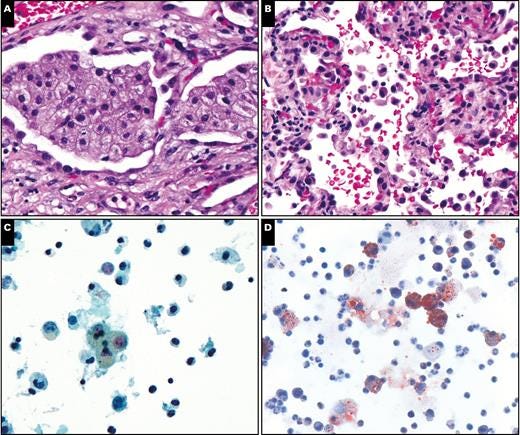 Macrophages in vaping-related lung injury. A, Foamy macrophages within airspaces, case 3 (H&E, ×400). B, Few intra-alveolar macrophages without distinctive features, case 2 (H&E, ×400). C, Macrophages in bronchoalveolar lavage fluid do not show prominent intracytoplasmic vacuoles (Papanicolaou stain, ×400). D, Oil red O–positive macrophages, case 4, courtesy of Margaret Compton, MD (oil red O, ×400).