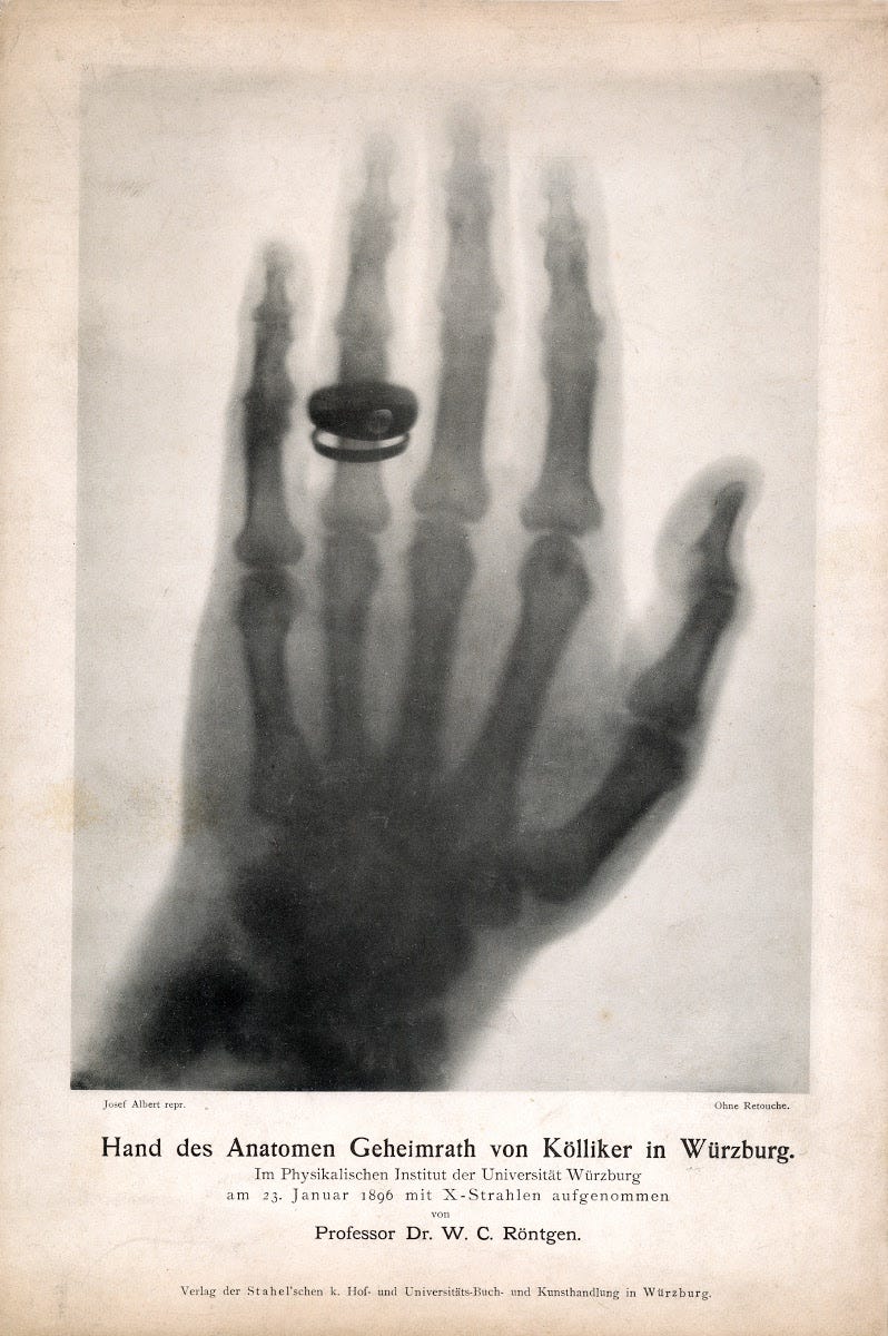 Picture of the hand of the anatomist Albert von Kölliker taken on the  occasion of the first public lecture on January 23, 1896. - W.C. Röntgen —  Google Arts & Culture