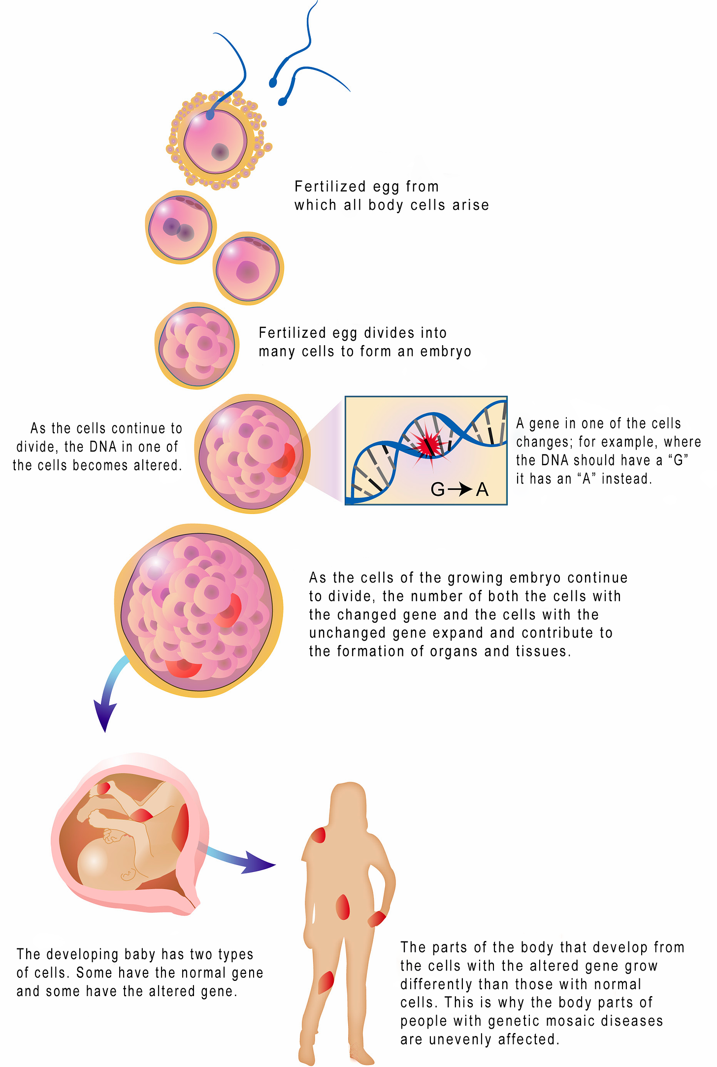 https://www.lgdalliance.org/genetic-mosaisism-graphic-2/
